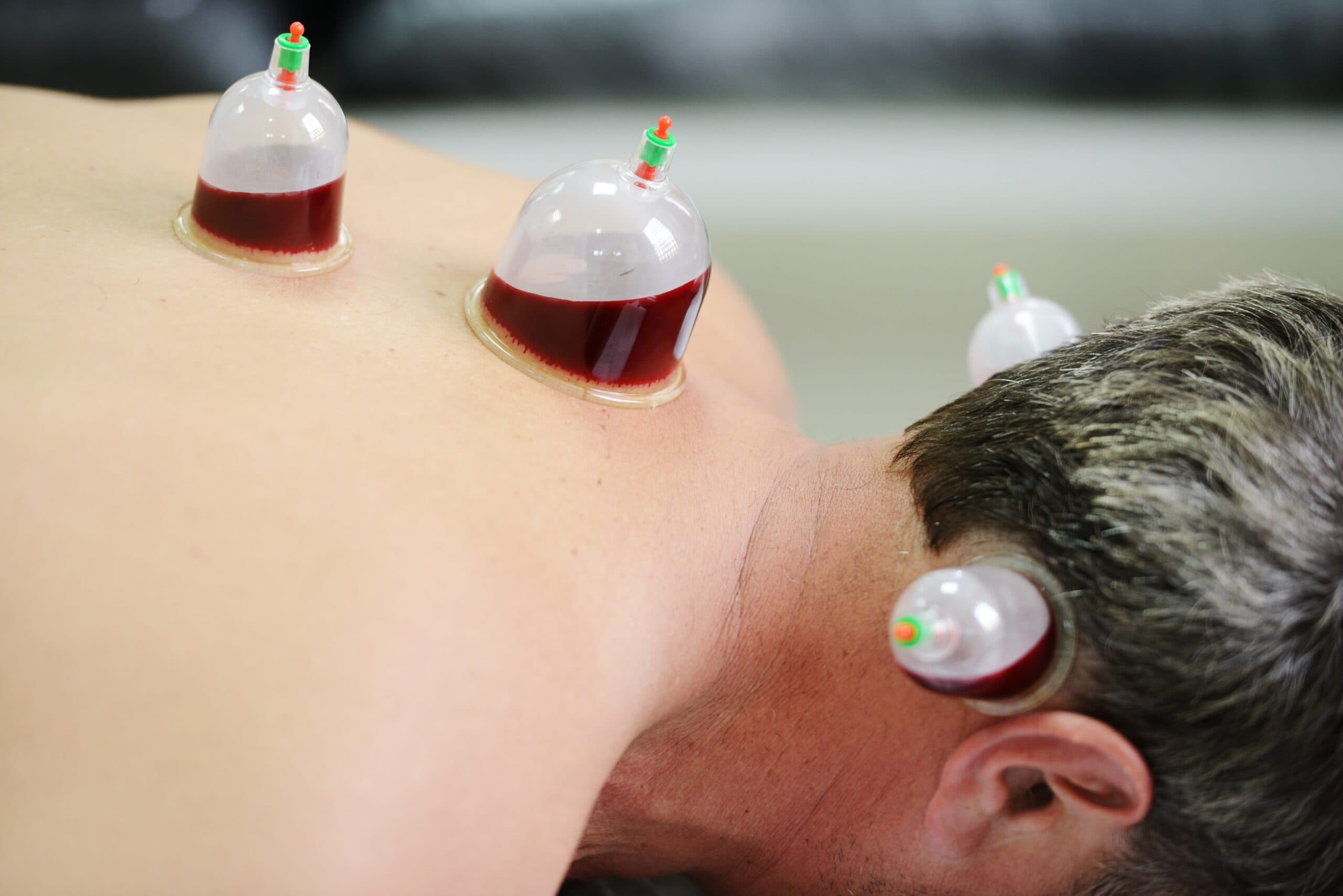 Hijama: The Complete Guide to Wet Cupping Therapy