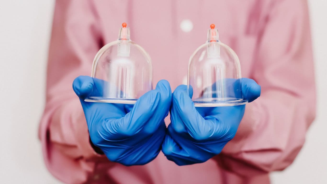 Hijama wet cupping practice