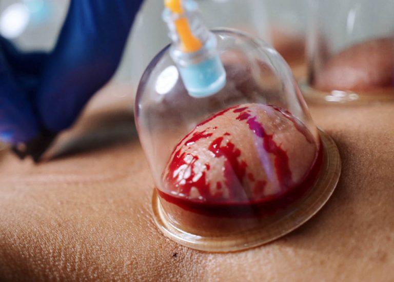 Wet Cupping Hijama Nation