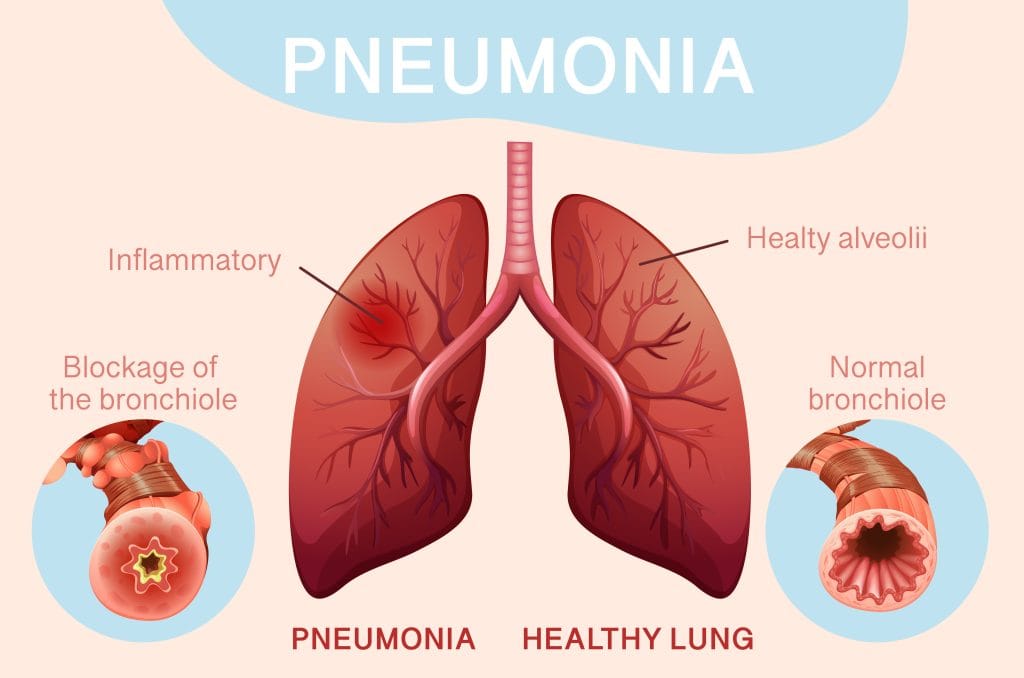 Hijama Treatment for Pneumonia