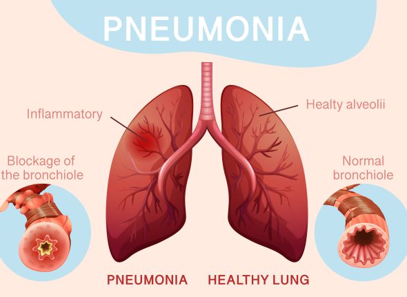 Hijama Treatment for Pneumonia