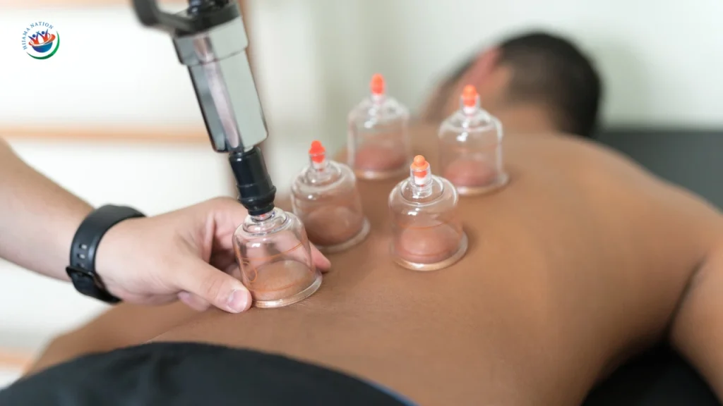 Dry Cupping Hijama Nation