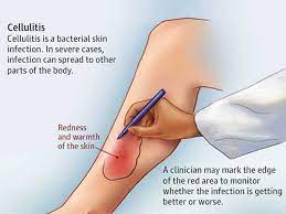 Hijama Treatment Plan For Cellulitis