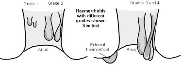 Hijama Treatment For Haemorrhoids