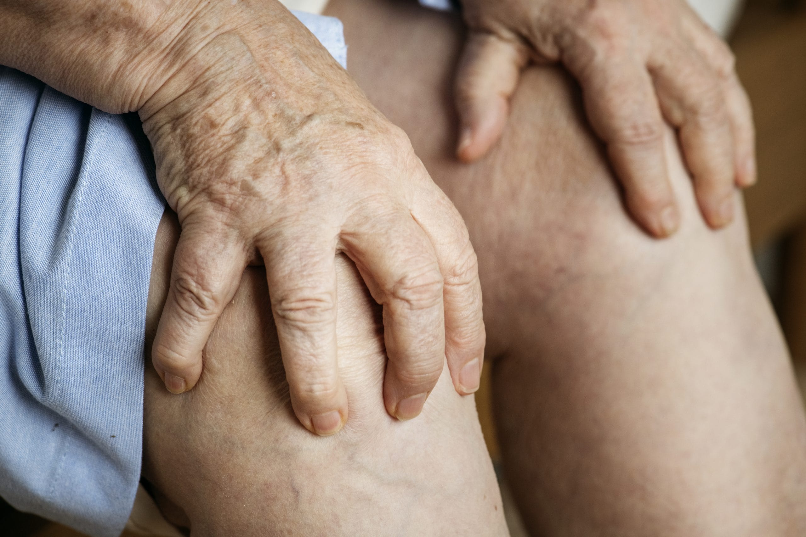 hijama treamtent for oedema
