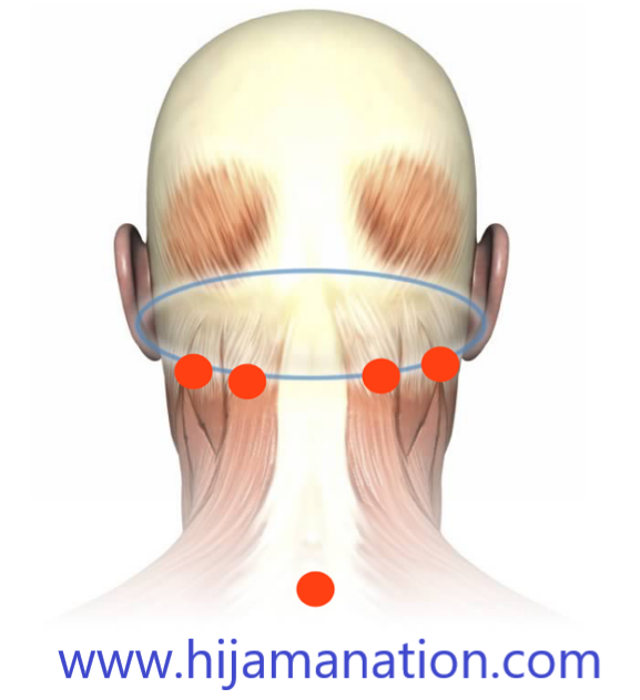 hijma cupping therapy