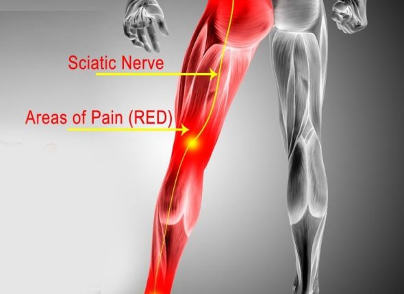 Hijama Points For Sciatic Nerve