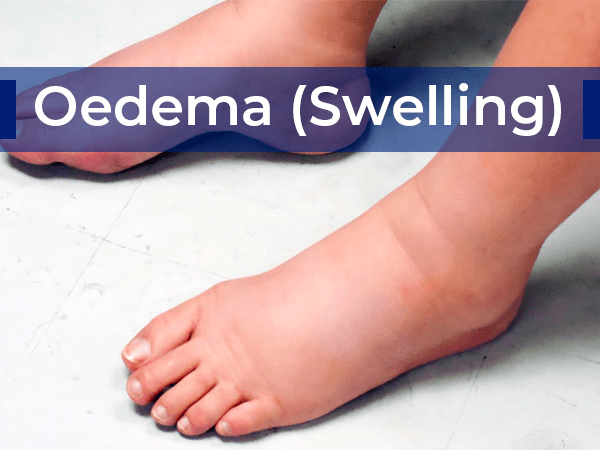 Hijama Treatment For Oedema