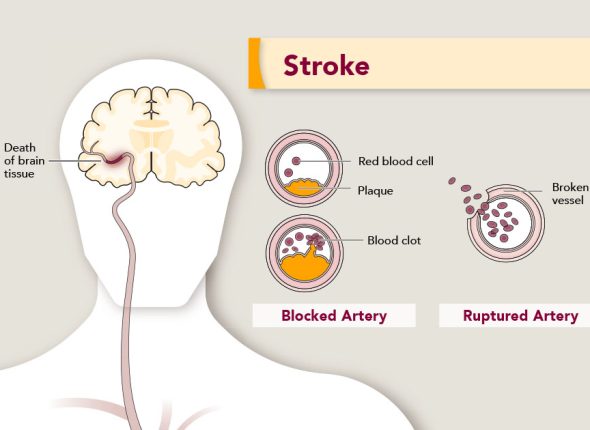 Hijama Points For Rehabilitation Of Stroke