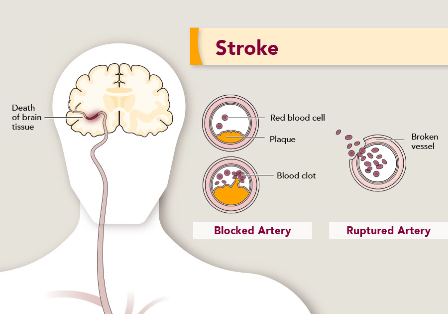 Hijama Points For Rehabilitation Of Stroke