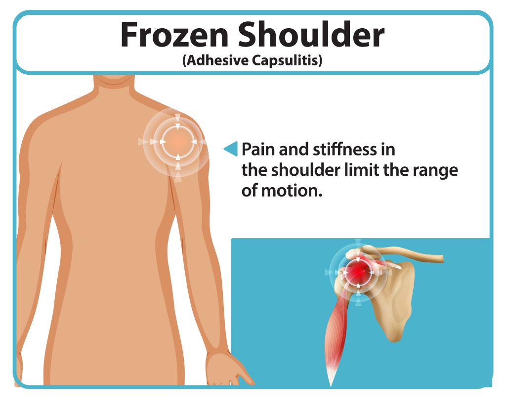 Cupping Therapy for Frozen Shoulder