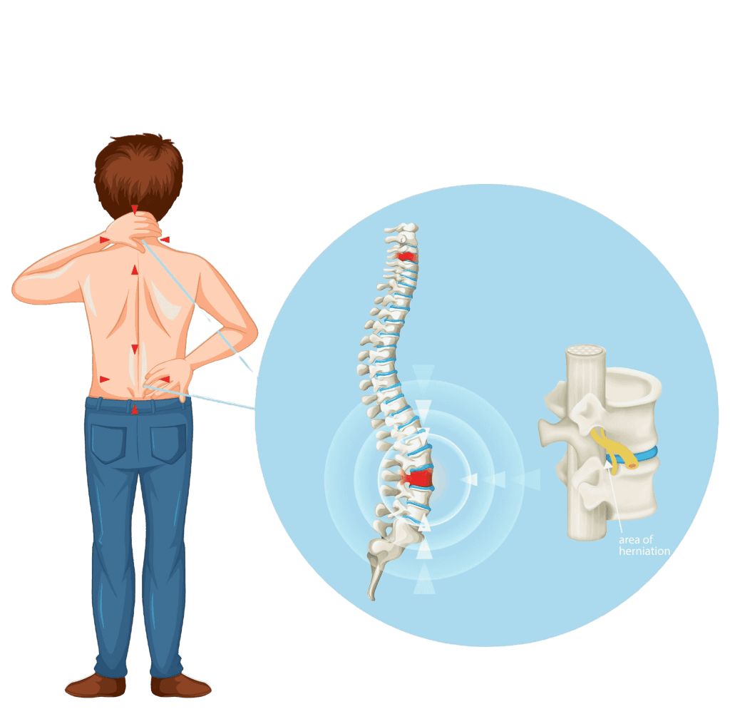 Herniated Disc Hip pain