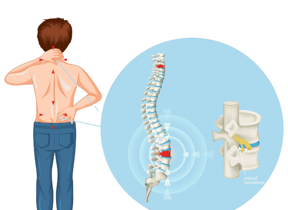 Herniated Disc Hip pain